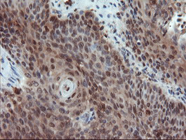 PYCARD / ASC / TMS1 Antibody - IHC of paraffin-embedded Carcinoma of Human bladder tissue using anti-PYCARD mouse monoclonal antibody.