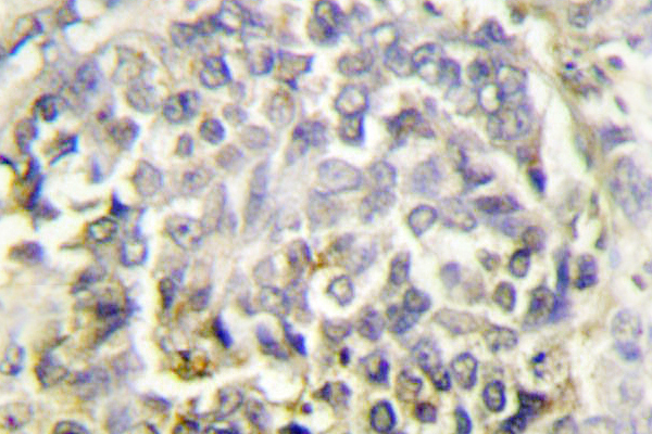 PYCARD / ASC / TMS1 Antibody - IHC of ASC (E13) pAb in paraffin-embedded human lung carcinoma tissue.