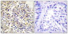PYCARD / ASC / TMS1 Antibody - Peptide - + Immunohistochemistry analysis of paraffin-embedded human lung carcinoma tissue using ASC antibody.