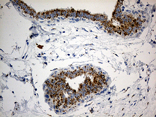 PYCR1 Antibody - Immunohistochemical staining of paraffin-embedded Human breast tissue within the normal limits using anti-PYCR1 mouse monoclonal antibody. (Heat-induced epitope retrieval by 1mM EDTA in 10mM Tris buffer. (pH8.5) at 120°C for 3 min. (1:500)