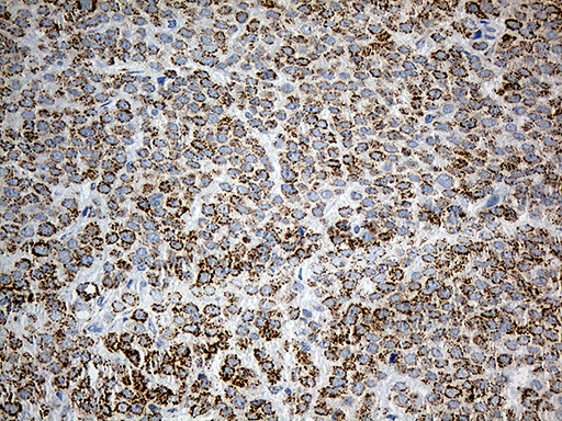 PYCR1 Antibody - Immunohistochemical staining of paraffin-embedded Adenocarcinoma of Human breast tissue tissue using anti-PYCR1 mouse monoclonal antibody. (Heat-induced epitope retrieval by 1mM EDTA in 10mM Tris buffer. (pH8.5) at 120°C for 3 min. (1:500)