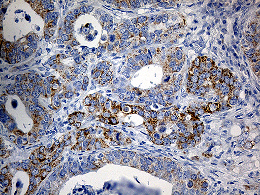 PYCR1 Antibody - Immunohistochemical staining of paraffin-embedded Human Gastric Carcinoma using anti-PYCR1 mouse monoclonal antibody. (Heat-induced epitope retrieval by 1mM EDTA in 10mM Tris buffer. (pH8.5) at 120°C for 3 min. (1:500)