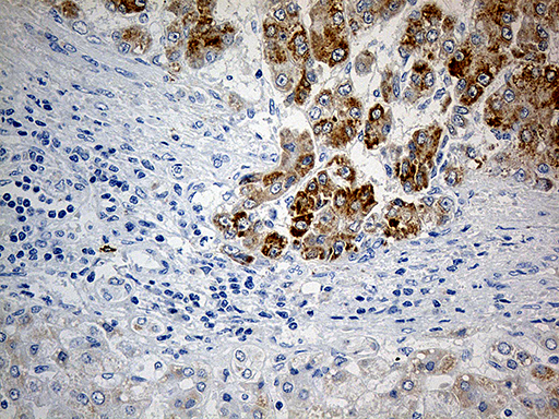 PYCR1 Antibody - Immunohistochemical staining of paraffin-embedded Carcinoma of Human liver tissue using anti-PYCR1 mouse monoclonal antibody. (Heat-induced epitope retrieval by 1mM EDTA in 10mM Tris buffer. (pH8.5) at 120°C for 3 min. (1:500)