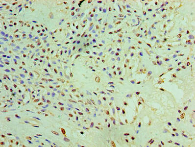 PYCR1 Antibody - Immunohistochemistry of paraffin-embedded human breast cancer using PYCR1 Antibody at dilution of 1:100