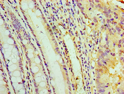 PYCR1 Antibody - Immunohistochemistry of paraffin-embedded human colon cancer using PYCR1 Antibody at dilution of 1:100