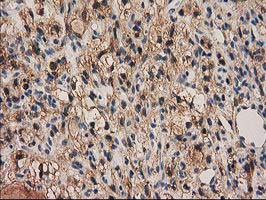 PYCRL Antibody - IHC of paraffin-embedded Carcinoma of Human kidney tissue using anti-PYCRL mouse monoclonal antibody.