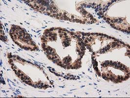 PYCRL Antibody - IHC of paraffin-embedded Carcinoma of Human prostate tissue using anti-PYCRL mouse monoclonal antibody.