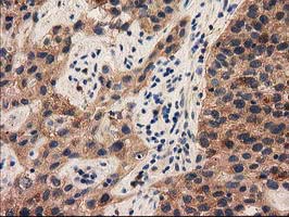 PYCRL Antibody - IHC of paraffin-embedded Carcinoma of Human bladder tissue using anti-PYCRL mouse monoclonal antibody.