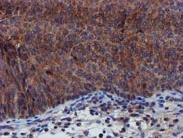 PYCRL Antibody - IHC of paraffin-embedded Carcinoma of Human bladder tissue using anti-PYCRL mouse monoclonal antibody.