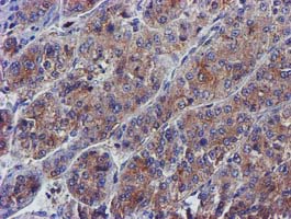 PYCRL Antibody - IHC of paraffin-embedded Carcinoma of Human liver tissue using anti-PYCRL mouse monoclonal antibody.
