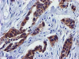 PYCRL Antibody - IHC of paraffin-embedded Carcinoma of Human lung tissue using anti-PYCRL mouse monoclonal antibody.