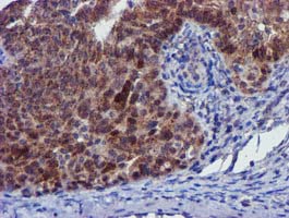 PYCRL Antibody - IHC of paraffin-embedded Adenocarcinoma of Human ovary tissue using anti-PYCRL mouse monoclonal antibody.