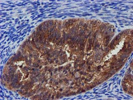 PYCRL Antibody - IHC of paraffin-embedded Adenocarcinoma of Human endometrium tissue using anti-PYCRL mouse monoclonal antibody.