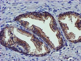PYCRL Antibody - IHC of paraffin-embedded Carcinoma of Human prostate tissue using anti-PYCRL mouse monoclonal antibody.