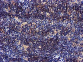 PYCRL Antibody - IHC of paraffin-embedded Human lymphoma tissue using anti-PYCRL mouse monoclonal antibody.