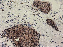 PYCRL Antibody - IHC of paraffin-embedded Adenocarcinoma of Human breast tissue using anti-PYCRL mouse monoclonal antibody.