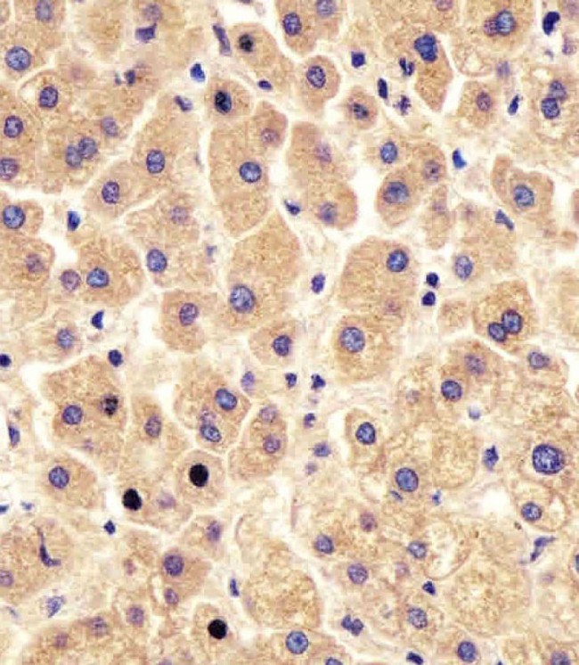 PYGL Antibody - Antibody staining PYGL in human liver tissue sections by Immunohistochemistry (IHC-P - paraformaldehyde-fixed, paraffin-embedded sections). Tissue was fixed with formaldehyde and blocked with 3% BSA for 0. 5 hour at room temperature; antigen retrieval was by heat mediation with a citrate buffer (pH 6). Samples were incubated with primary antibody (1:25) for 1 hours at 37°C. A undiluted biotinylated goat polyvalent antibody was used as the secondary antibody.