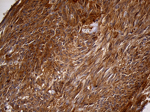 PYGM Antibody - Immunohistochemical staining of paraffin-embedded Human gastric stromal tumor tissue using anti-PYGM mouse monoclonal antibody. (Heat-induced epitope retrieval by 1mM EDTA in 10mM Tris buffer. (pH8.5) at 120°C for 3 min. (1:2000)