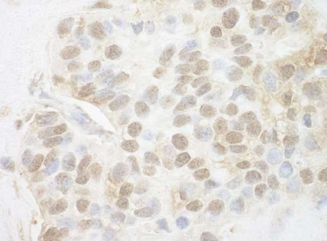 PYGO2 / Pygopus 2 Antibody - Detection of Human Pygo2 by Immunohistochemistry. Sample: FFPE section of human breast carcinoma. Antibody: Affinity purified rabbit anti-Pygo2 used at a dilution of 1:200 (1 ug/mg).