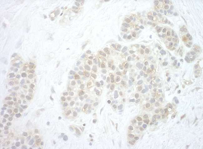 PYGO2 / Pygopus 2 Antibody - Detection of Human Pygo2 by Immunohistochemistry. Sample: FFPE section of human breast carcinoma. Antibody: Affinity purified rabbit anti-Pygo2 used at a dilution of 1:1000 (1 ug/mg).