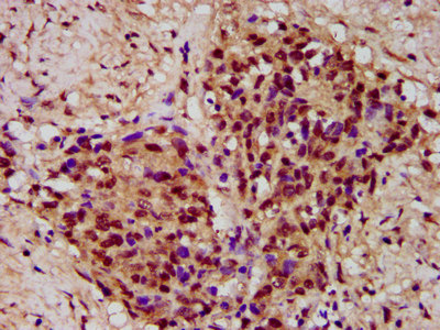 PYGO2 / Pygopus 2 Antibody - Immunohistochemistry image at a dilution of 1:300 and staining in paraffin-embedded human ovarian cancer performed on a Leica BondTM system. After dewaxing and hydration, antigen retrieval was mediated by high pressure in a citrate buffer (pH 6.0) . Section was blocked with 10% normal goat serum 30min at RT. Then primary antibody (1% BSA) was incubated at 4 °C overnight. The primary is detected by a biotinylated secondary antibody and visualized using an HRP conjugated SP system.