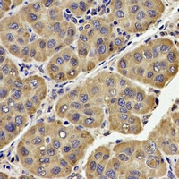 QCR2 / UQCRC2 Antibody - Immunohistochemical analysis of UQCRC2 staining in human liver cancer formalin fixed paraffin embedded tissue section. The section was pre-treated using heat mediated antigen retrieval with sodium citrate buffer (pH 6.0). The section was then incubated with the antibody at room temperature and detected using an HRP conjugated compact polymer system. DAB was used as the chromogen. The section was then counterstained with hematoxylin and mounted with DPX.