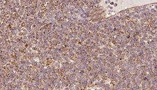 QCR2 / UQCRC2 Antibody - 1:100 staining human lymph carcinoma tissue by IHC-P. The sample was formaldehyde fixed and a heat mediated antigen retrieval step in citrate buffer was performed. The sample was then blocked and incubated with the antibody for 1.5 hours at 22°C. An HRP conjugated goat anti-rabbit antibody was used as the secondary.