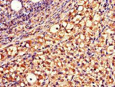 QDPR / DHPR Antibody - Immunohistochemistry of paraffin-embedded human ovarian cancer using QDPR Antibody at dilution of 1:100