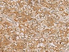 QDPR / DHPR Antibody - Immunohistochemistry of paraffin-embedded Human liver cancer tissue  using QDPR Polyclonal Antibody at dilution of 1:70(×200)