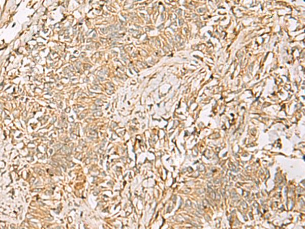 QDPR / DHPR Antibody - Immunohistochemistry of paraffin-embedded Human ovarian cancer tissue  using QDPR Polyclonal Antibody at dilution of 1:70(×200)