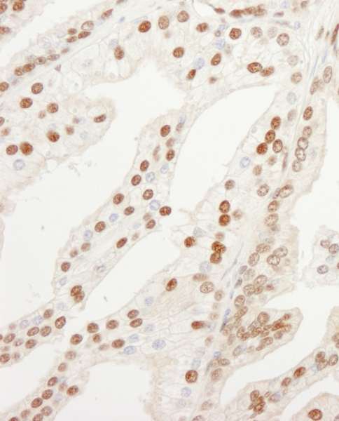 QIP1 / KPNA4 Antibody - Detection of Human KPNA4 by Immunohistochemistry. Sample: FFPE section of human prostate carcinoma. Antibody: Affinity purified rabbit anti-KPNA4 used at a dilution of 1:200 (1 Detection: DAB.