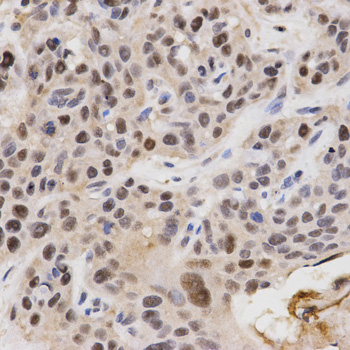 QIP1 / KPNA4 Antibody - Immunohistochemistry of paraffin-embedded human esophageal cancer tissue.