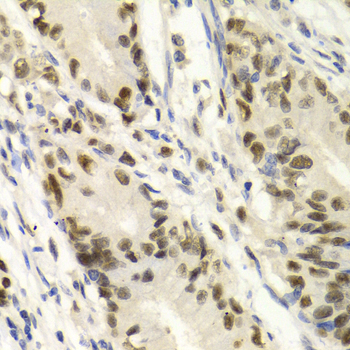 QIP1 / KPNA4 Antibody - Immunohistochemistry of paraffin-embedded Human gastric cancer tissue.