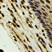QIP1 / KPNA4 Antibody - Immunohistochemical analysis of Karyopherin alpha-4 staining in human esophageal cancer formalin fixed paraffin embedded tissue section. The section was pre-treated using heat mediated antigen retrieval with sodium citrate buffer (pH 6.0). The section was then incubated with the antibody at room temperature and detected using an HRP conjugated compact polymer system. DAB was used as the chromogen. The section was then counterstained with hematoxylin and mounted with DPX.