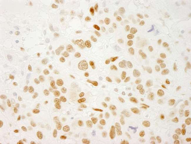 QKI Antibody - Detection of Human QKI by Immunohistochemistry. Sample: FFPE section of human breast carcinoma. Antibody: Affinity purified rabbit anti-QKI used at a dilution of 1:250. Epitope Retrieval Buffer-High pH (IHC-101J) was substituted for Epitope Retrieval Buffer-Reduced pH.