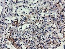 QPRT Antibody - IHC of paraffin-embedded Carcinoma of Human kidney tissue using anti-QPRT mouse monoclonal antibody.
