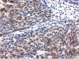 QPRT Antibody - IHC of paraffin-embedded Adenocarcinoma of Human ovary tissue using anti-QPRT mouse monoclonal antibody.