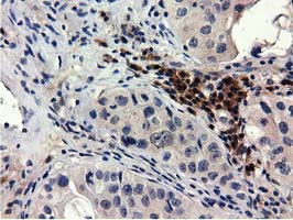 QPRT Antibody - IHC of paraffin-embedded Carcinoma of Human bladder tissue using anti-QPRT mouse monoclonal antibody.