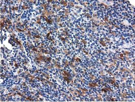 QPRT Antibody - IHC of paraffin-embedded Human lymphoma tissue using anti-QPRT mouse monoclonal antibody.
