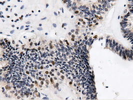 QPRT Antibody - Immunohistochemical staining of paraffin-embedded Adenocarcinoma of Human endometrium tissue using anti-QPRT mouse monoclonal antibody.