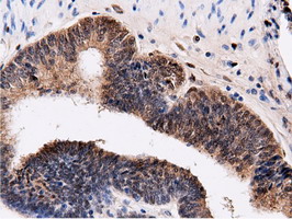 QPRT Antibody - IHC of paraffin-embedded Adenocarcinoma of Human endometrium tissue using anti-QPRT mouse monoclonal antibody.