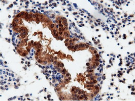 QPRT Antibody - IHC of paraffin-embedded Carcinoma of Human prostate tissue using anti-QPRT mouse monoclonal antibody.