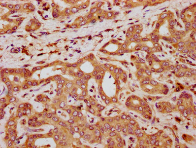 QPRT Antibody - Immunohistochemistry Dilution at 1:300 and staining in paraffin-embedded human liver cancer performed on a Leica BondTM system. After dewaxing and hydration, antigen retrieval was mediated by high pressure in a citrate buffer (pH 6.0). Section was blocked with 10% normal Goat serum 30min at RT. Then primary antibody (1% BSA) was incubated at 4°C overnight. The primary is detected by a biotinylated Secondary antibody and visualized using an HRP conjugated SP system.