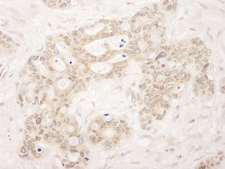 QSER1 Antibody - Detection of Human QSER1 Immunohistochemistry. Sample: FFPE section of human ovarian carcinoma. Antibody: Affinity purified rabbit anti-QSER used at a dilution of 1:250.