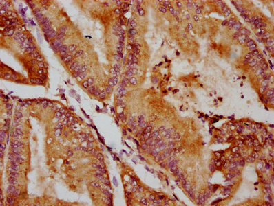 QSOX1 / QSCN6 Antibody - Immunohistochemistry Dilution at 1:400 and staining in paraffin-embedded human endometrial cancer performed on a Leica BondTM system. After dewaxing and hydration, antigen retrieval was mediated by high pressure in a citrate buffer (pH 6.0). Section was blocked with 10% normal Goat serum 30min at RT. Then primary antibody (1% BSA) was incubated at 4°C overnight. The primary is detected by a biotinylated Secondary antibody and visualized using an HRP conjugated SP system.