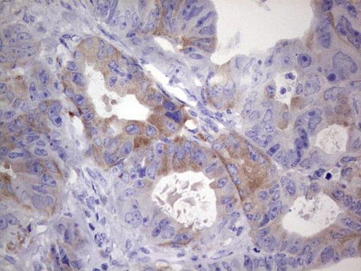 R1 / RRM1 Antibody - Immunohistochemical staining of paraffin-embedded Adenocarcinoma of Human colon tissue using anti-RRM1 Mouse monoclonal antibody.  heat-induced epitope retrieval by 1 mM EDTA in 10mM Tris, pH8.5, 120C for 3min)