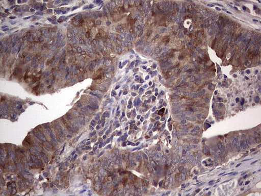 R1 / RRM1 Antibody - Immunohistochemical staining of paraffin-embedded Adenocarcinoma of Human colon tissue using anti-RRM1 mouse monoclonal antibody. (Heat-induced epitope retrieval by 1 mM EDTA in 10mM Tris, pH8.5, 120C for 3min,