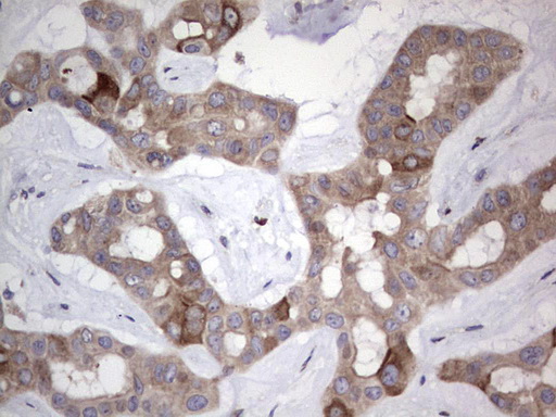 R1 / RRM1 Antibody - Immunohistochemical staining of paraffin-embedded Carcinoma of Human liver tissue using anti-RRM1 mouse monoclonal antibody. (Heat-induced epitope retrieval by 1 mM EDTA in 10mM Tris, pH8.5, 120C for 3min,