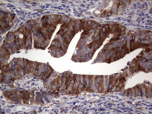 R1 / RRM1 Antibody - IHC of paraffin-embedded Adenocarcinoma of Human colon tissue using anti-RRM1 mouse monoclonal antibody. (Heat-induced epitope retrieval by 1 mM EDTA in 10mM Tris, pH8.5, 120°C for 3min).
