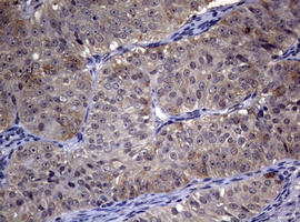 R1 / RRM1 Antibody - IHC of paraffin-embedded Adenocarcinoma of Human ovary tissue using anti-RRM1 mouse monoclonal antibody.